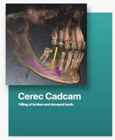 CEREC CADCAM Dentistry