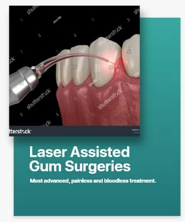 Laser Assisted Gum Surgeries