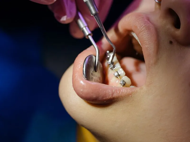 Ceramic Braces at Shwetha Dentistry, Kalaburagi