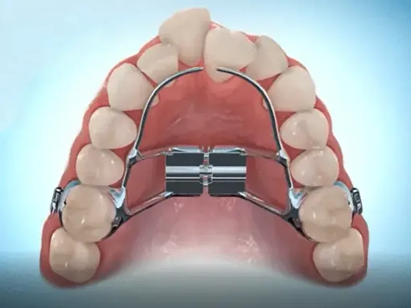 Palatal Expanders at Shwetha Dentistry, Kalaburagi